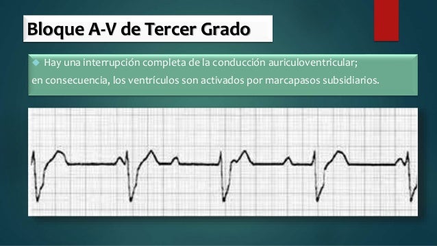 disociacion auriculoventricular